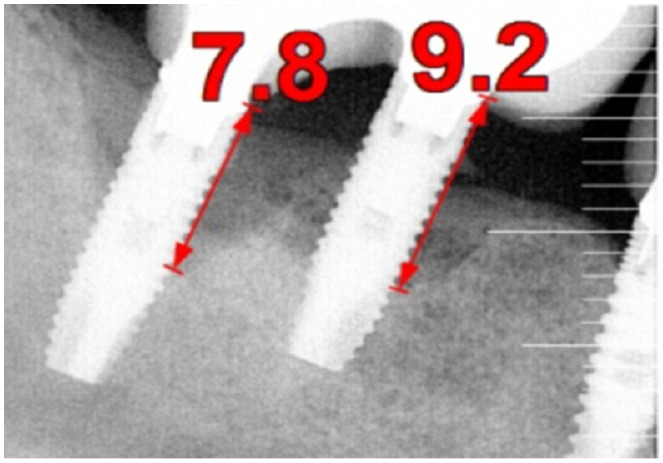 Periapical radiograph of two lower right implants with red arrows marking 7.8 and 9.2 mm of bone loss from the implant platform