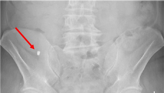 Postoperative abdominal X-ray showing the displaced implant in the colon
