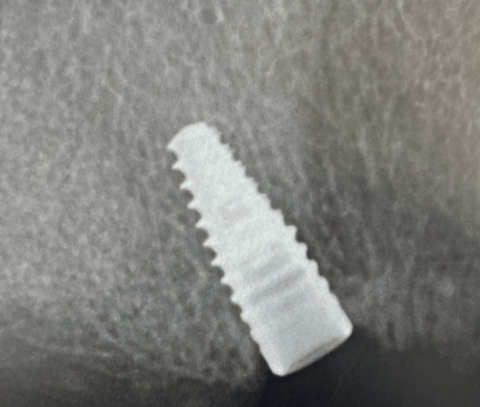 Periapical radiograph of a maxillary implant with a fractured prosthetic screw fragment inside its connection