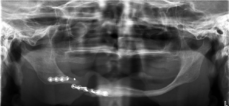 Panoramic radiograph of a pathological fracture of an extremely atrophied mandible