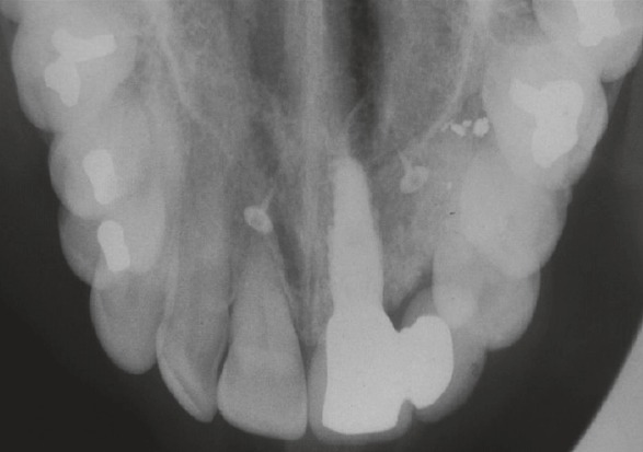 Occlusal radiograph showing the nasopalatine canal orifices
