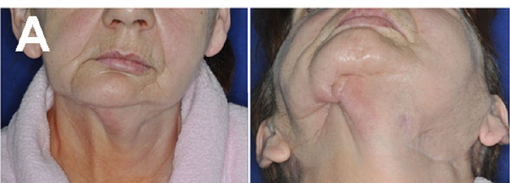 Frontal and submental photographs of the same patient at presentation, showing facial asymmetry and an orocutaneous fistula
