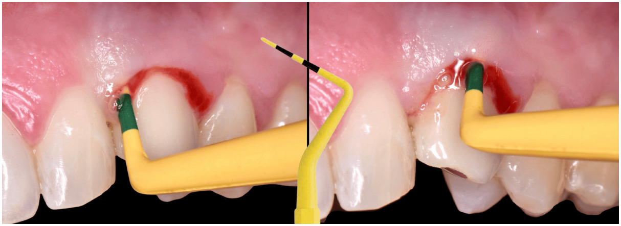 Bleeding on probing at an anterior maxillary implant