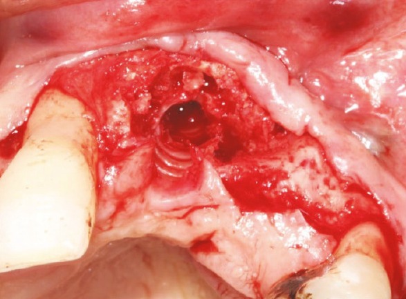 The implantotomy site immediately after the implant was unscrewed by hand