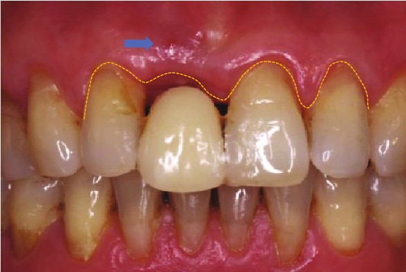Labial view showing a fistula and papillary recession beside the implant