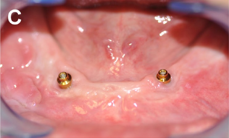 Intraoral view at six years showing two locator abutments in healthy keratinised tissue