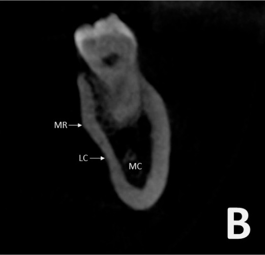Cross-sectional CBCT at the first and second molar showing the mylohyoid ridge, lingual concavity and mandibular canal