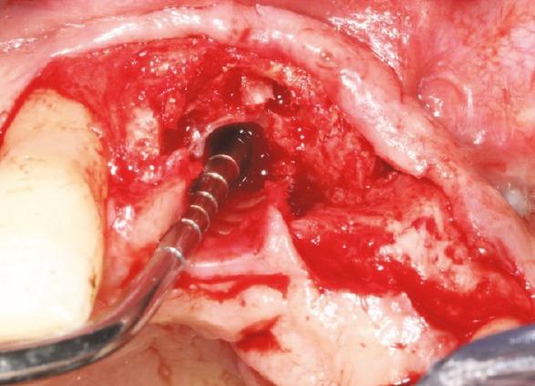 A probe passing from the osteotomy into the nasopalatine canal