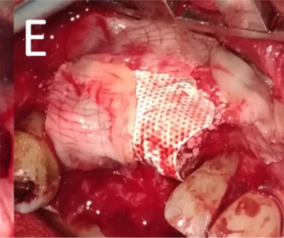 Coating with the L-PRF membrane