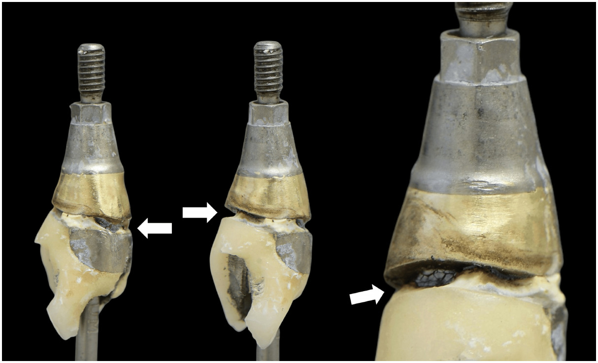 The retrieved implant restoration showing a deep contaminated margin