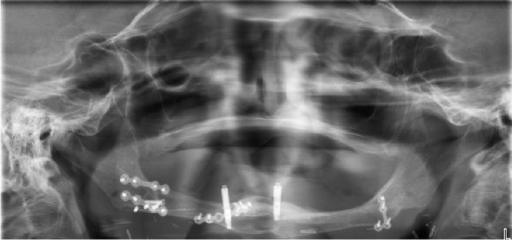 Panoramic radiograph six years after fibula reconstruction with two implants