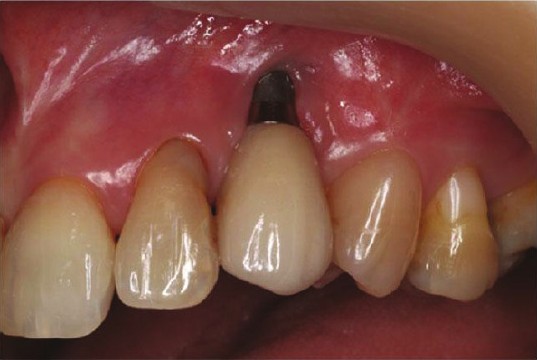 Soft tissue dehiscence exposing the implant fixture