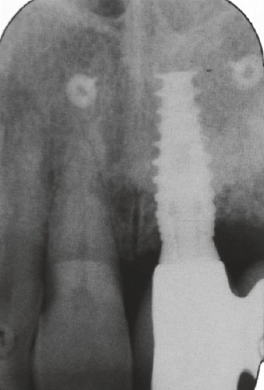 Periapical radiograph of the implant at UL1, reported as normal