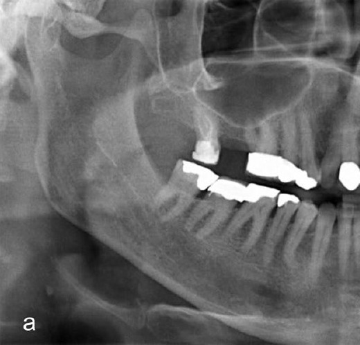 Planning panoramic of the posterior maxilla before implant placement