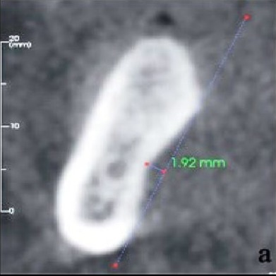 Cross-sectional CBCT showing a shallow submandibular fossa, type I