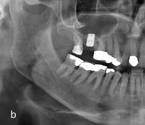Postoperative panoramic showing the implant correctly seated