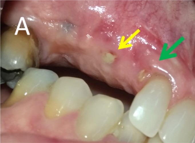 Small area of membrane exposure at three months
