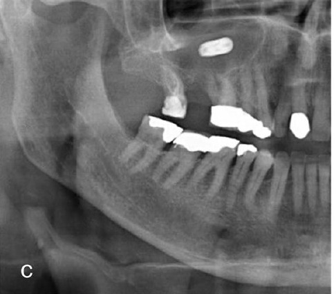 Panoramic showing the implant displaced into the right maxillary sinus