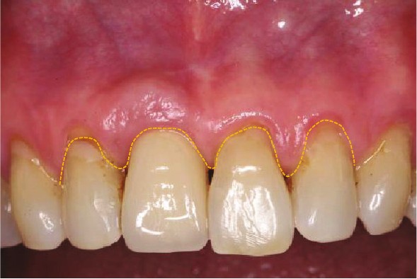 Labial view at eight years showing a stable soft tissue margin
