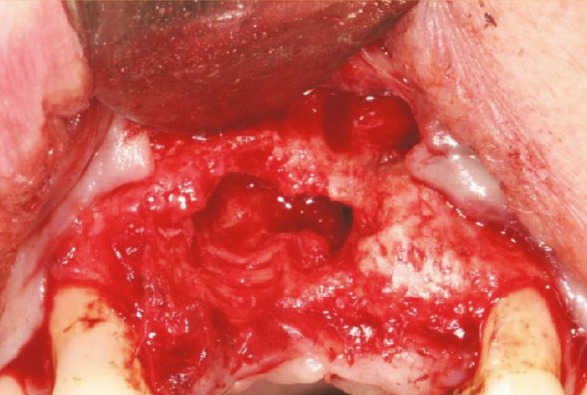 The debrided osteotomy showing the patent aberrant canal