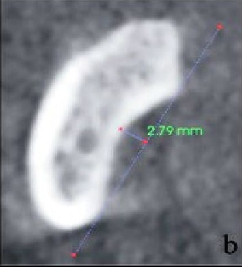 Cross-sectional CBCT showing a moderate submandibular fossa, type II