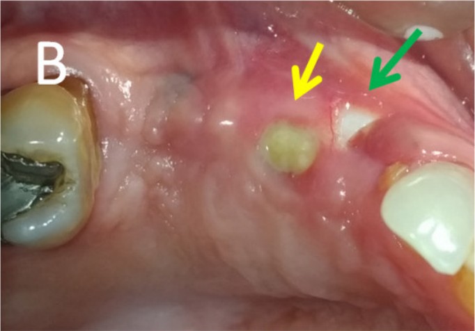 The exposed area is larger at four months